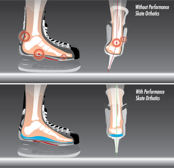 Skate Orthotics